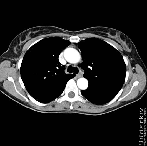 Thorax 22