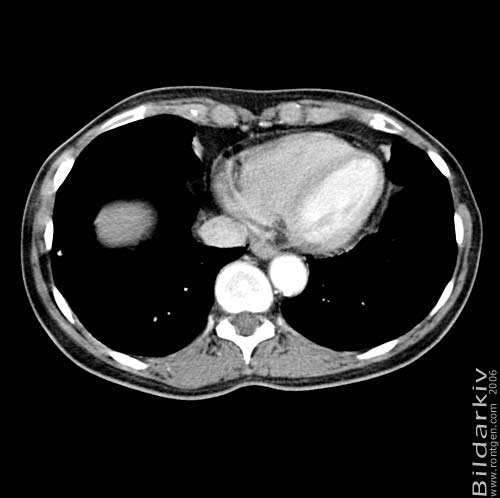 Thorax 45