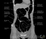 CT-colon med koldioxid coronar bildsnitt