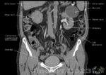 CT-urinvägar benign njurcysta