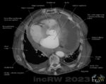 CT-thorax TBC utlöst pericardvätska