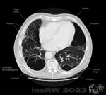 CT-thorax emfysem