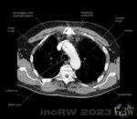 CT-thorax förstorad lymfkörtel