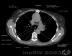 CT-thorax aorta ascendens aneurysm 5cm