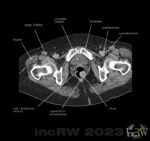 CT-colon rektal polyp