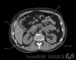 CT-urografi nativ fas