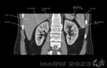 CT-urografi uppladdningsfas