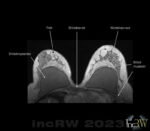 MR-bild bröstimplantat