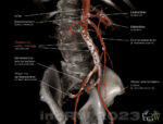 CT aorta med ateroskleros