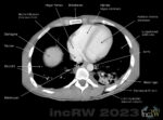 CT-thorax knivstick