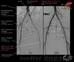 Angio bäckenartärer före och efter PTA