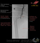 Angio akut kritisk ischemi tromb i lårbensartären 